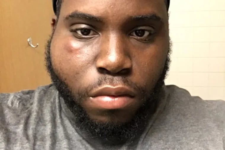 Dawan Wilson, a junior at Lock Haven University, with facial bruises. He has filed a complaint.