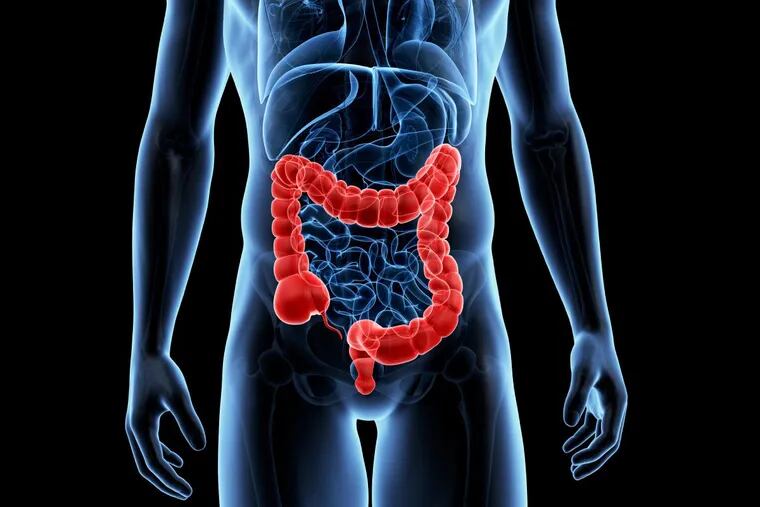 The human colon. Colorectal cancer occurs in the colon or rectum when abnormal growths, called polyps, form and become cancerous over time.