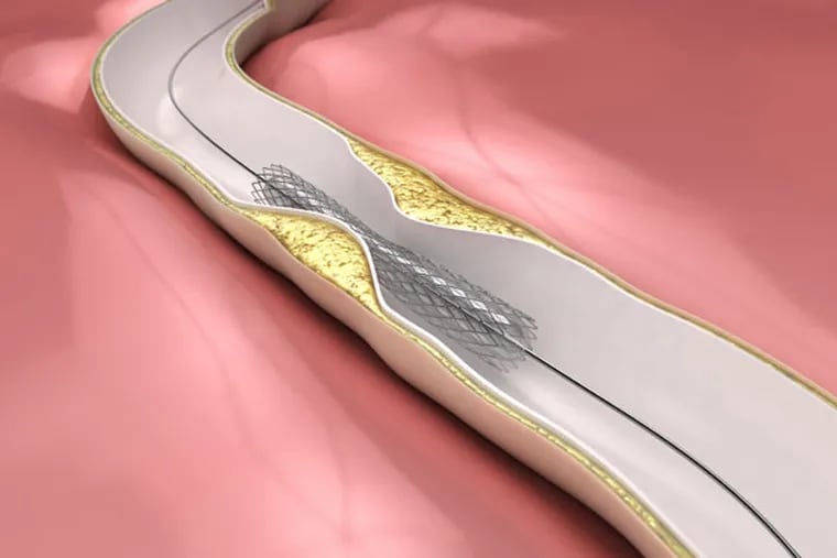 A stent is a small mesh tube that's used to treat narrow or weak arteries.