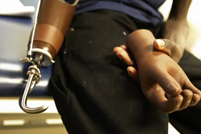 Ronald Okello with his two &quot;terminal devices&quot; - a metal hook and a mechanical hand covered with a urethane glove - that will attach to the wrist of his prosthesis arm. With training, Okello should be able to switch back and forth. The prosthetic arm will last about five years, but it&#0039;s unclear whether he will be able to get it replaced.