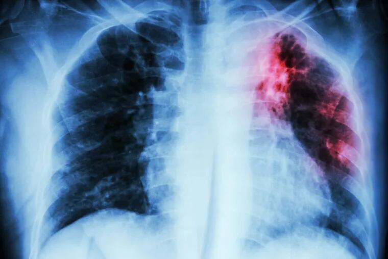 Idiopathic Pulmonary Fibrosis causes scarring of the lungs.
