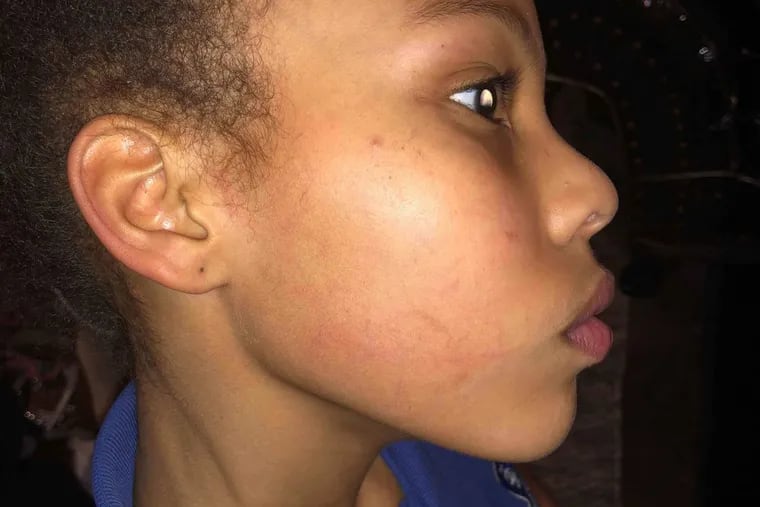 Zakiyah, 11, of Chester,  Delaware County, shows marks on the right side of her face after a fight on a school bus Tuesday, Feb. 13, 2018. Darby Borough Police arrested Zakiyah, handcuffed her, and held her at Darby Police Station. ( Courtesy of Jawania Browne )