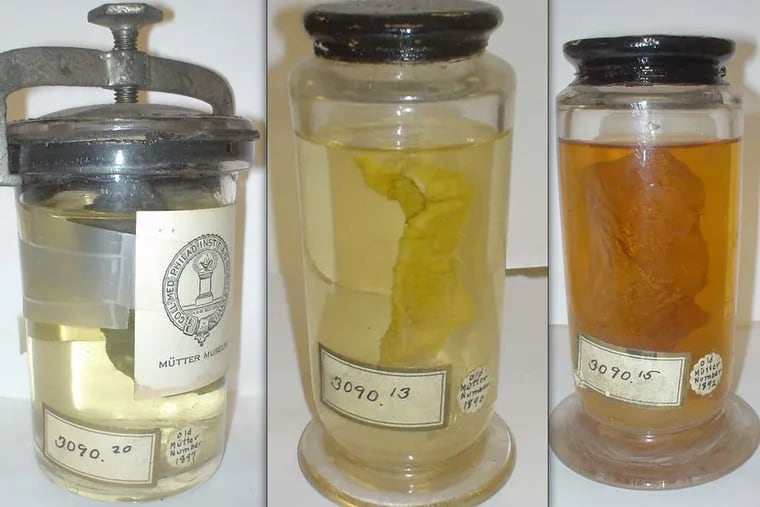 Intestines from victims of Philadelphia's 1849 cholera outbreak.