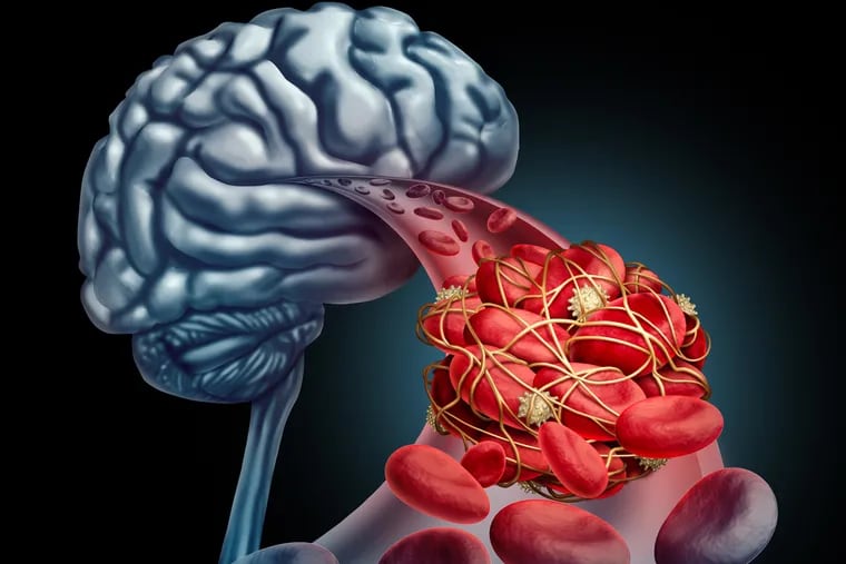 Ischemic strokes are caused by a blood clot that blocks a blood vessel in the brain. 87% of strokes are ischemic.