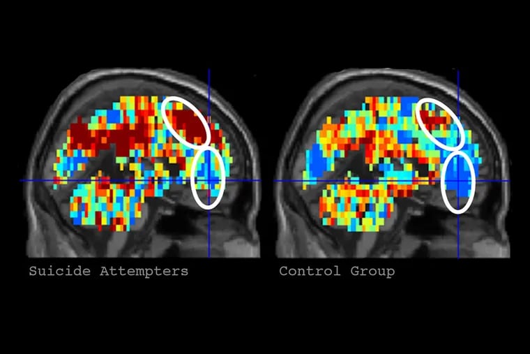 The brain scan related to the word "death" in participants who had made a suicide attempt (left) shows greater activation in areas associated with thoughts of self than the scan for control participants (right).