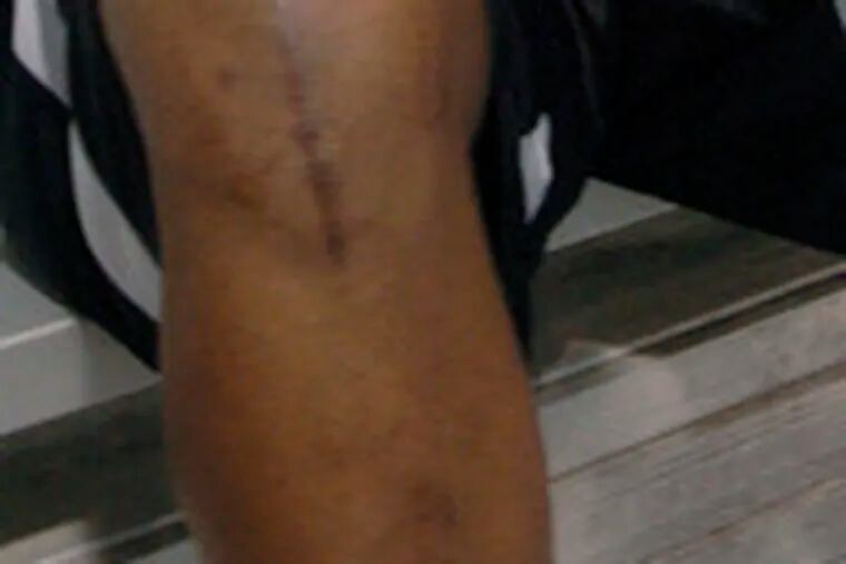 Donovan McNabb&#0039;s right knee sports scar from ACL surgery.