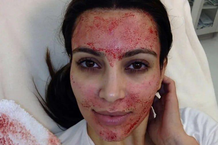 Kim Kardashian posted this image on Instagram in March 2013, showing the Vampire facial she received for her reality TV show, in which her own plasma was injected into her skin.