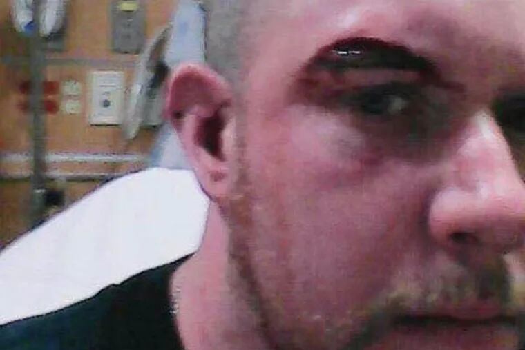 Paul Whitaker shows the gash he suffered in Juniata Park attack.