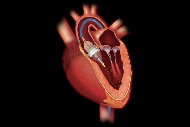 In a study of this replacement heart valve, which is inserted into the aorta with a catheter, patients were less likely to die or have a stroke than those who underwent surgery.