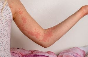 can cigarettes cause hives What causes hives and how dangerous can they be? A nurse practitioner  explains