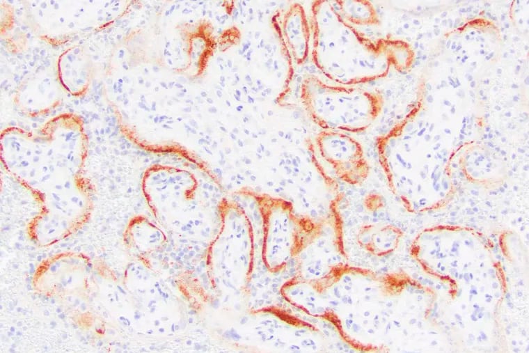 This microscope image provided by the College of American Pathologists and Archives of Pathology and Laboratory Medicine shows placental cells from a stillbirth with SARS-CoV-2 infection indicated by the darker stains. Research published on Thursday suggests the coronavirus can invade and destroy the placenta in a deadly process that may be a major cause of stillbirths in infected pregnant women.