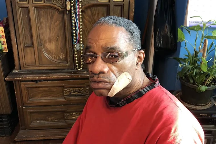 Glenn Hudson, 61, is recovering at his North Philadelphia home after he was shot in the jaw by a robber who took $20 on Jan. 16, 2019. The gunman and his four accomplices remain at large.