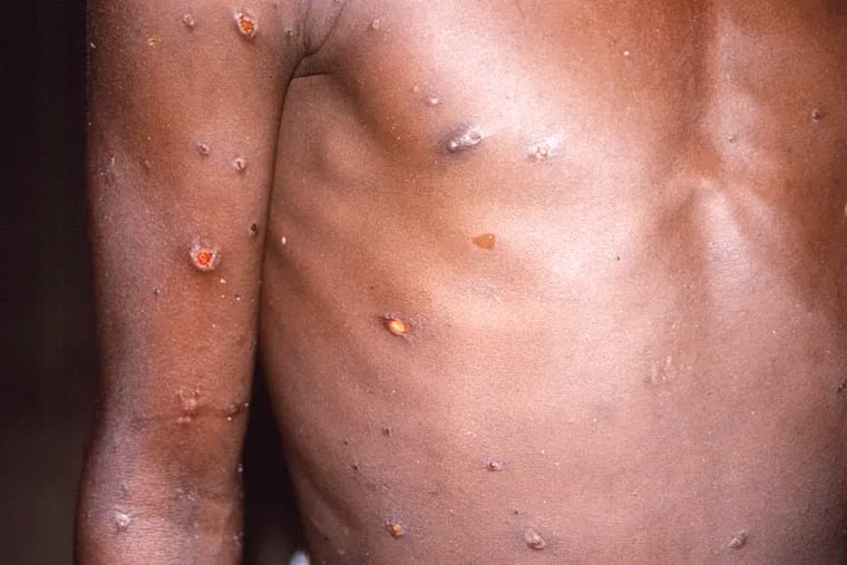 A 1997 image from U.S. Centers for Disease Control and Prevention shows the right arm and torso of a patient, whose skin displayed a number of lesions due to what had been an active case of monkeypox.