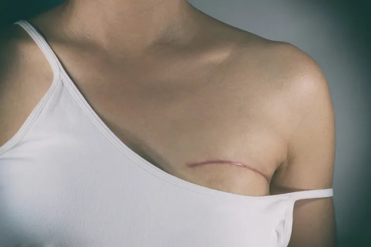 As plastic surgeons, one of the most common misconceptions we hear is that breast reconstruction is a cosmetic procedure and will not be covered by insurance. But that is not the case.