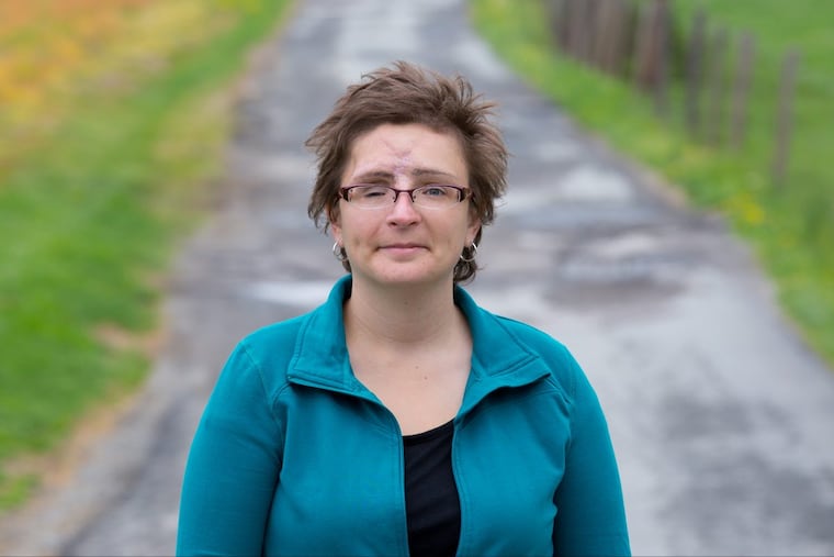 Melissa Smith bears the scars of her attempted suicide.