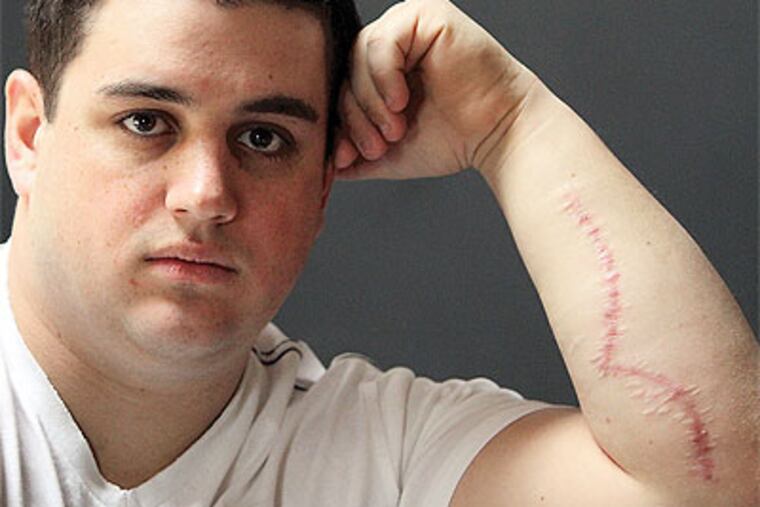 Dean Bowser shows his scar, a result of bouncers tossing him out of the Field House bar in Center City after a tussle over a credit card. (Joseph Kaczmarek / For the Daily News)