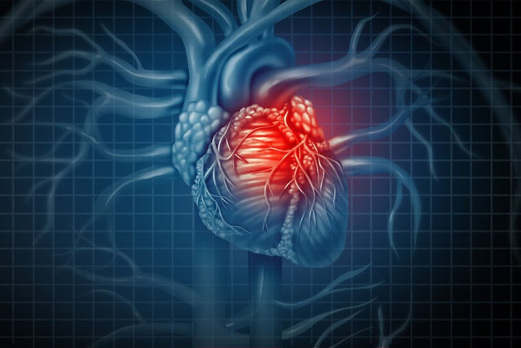 Some people don’t experience the classic symptoms of a heart attack, or don’t experience them as severely. This is known as an atypical presentation, or “silent” heart attack.