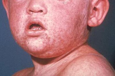 Mmrv Rashes CHOP vaccination expert recommends MMR vaccine after measles outbreak ...