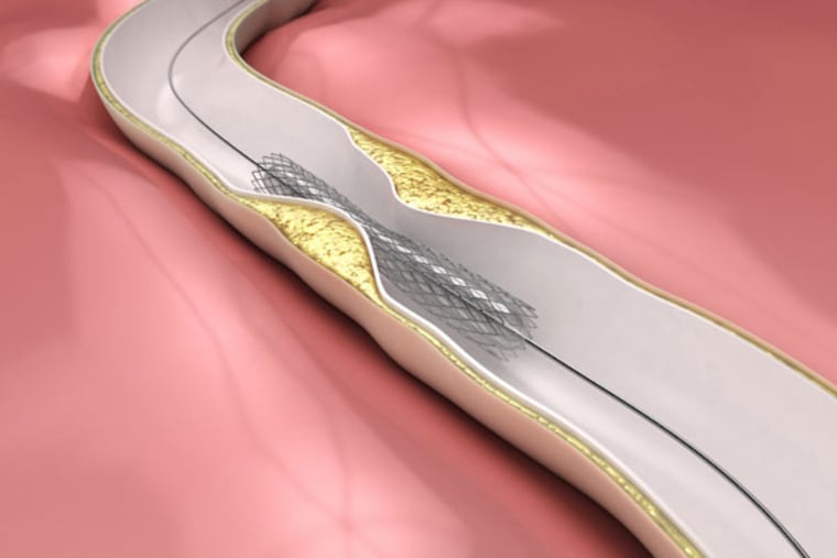 A stent is a small mesh tube that's used to treat narrow or weak arteries.