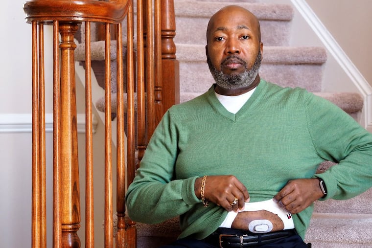 Trevis Hall, of Fort Washington, Maryland, credits a continuous glucose monitor with helping him get his diabetes under control. Makers of the device say that the instant feedback provides a way to motivate healthier eating and exercise. But experts point out that the few studies on the monitors show conflicting results.