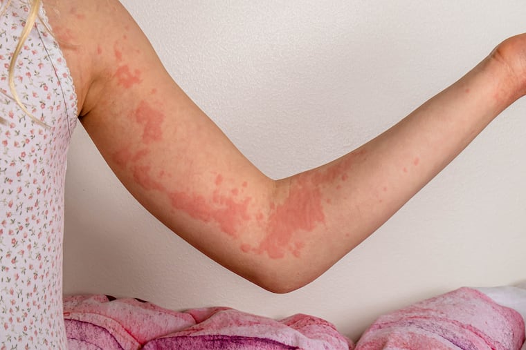 Hives on a girl's arm.