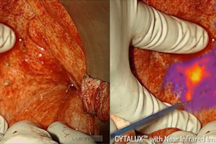 The photo on the left show the surgical site in white light. The image on the right is the same site with Cytalux and the near-infrared imaging.