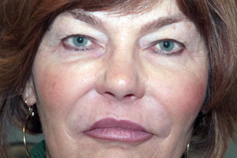 Lynn Shapiro before facial injections and blepharoplasty.