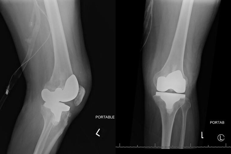 X-rays of the patient’s infected knee.