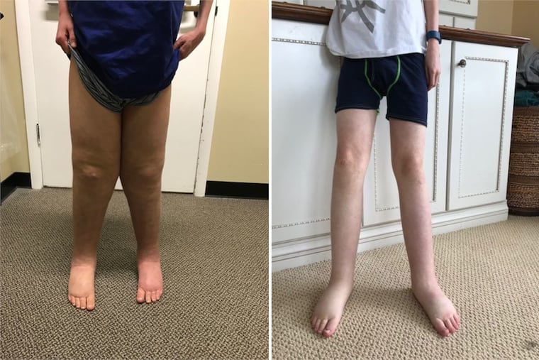 Puzzled by chronic swelling in the organs and legs of an adolescent boy, Children's Hospital of Philadelphia doctors discovered he had a rare genetic mutation, and successfully treated him with a drug normally used for cancer. The swelling in his legs, (at left, just before his 13th birthday), subsided dramatically within six months of treatment.