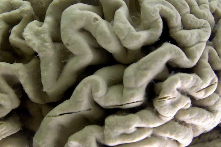The Alzheimer's Foundation of America will host a free education training in Philadelphia on November 15. The photo shows a closeup of a human brain affected by Alzheimer's disease, on display at the Museum of Neuroanatomy at the University at Buffalo in Buffalo, N.Y.