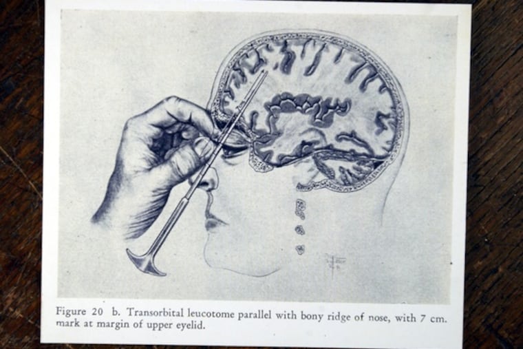 Even after the truth was known about lobotomy - shown in this medical illustration at the Mutter Museum - some doctors clung to their mistaken belief in the procedure, an especially dangerous example of a cognitive bias.