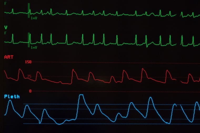 A monitor with a black screen showing atrial fibrillation on the green lines, arterial blood pressure on the red line and oxygen saturation on the blue line.