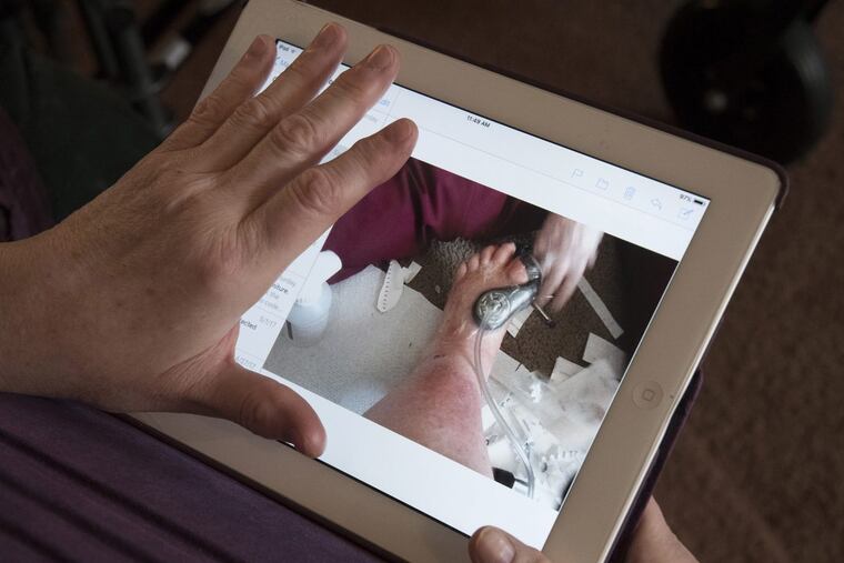 Carol Emanuele of Philadelphia shows a photograph of a wound VAC (vacuum-assisted closure) procedure on her left foot after the amputation of her big toe.