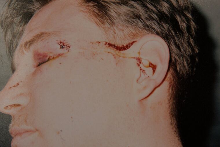 Michael Higgins (left), of Northeast Philly, says two cops beat him so badly onJan. 1 that he is nearly blind in his left eye.