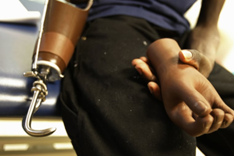 Ronald Okello with his two "terminal devices" - a metal hook and a mechanical hand covered with a urethane glove - that will attach to the wrist of his prosthesis arm. With training, Okello should be able to switch back and forth. The prosthetic arm will last about five years, but it's unclear whether he will be able to get it replaced.
