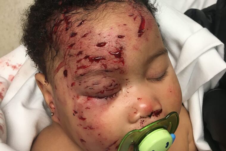 Journi Black after she was attacked by a raccoon