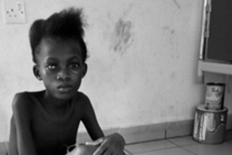 This girl, severely malnourished, is blind in her right eye due to Vitamin A deficiency. She's a patient at St. John of God Hospital, outside Freetown, where Dan Kelly trained with a local doctor, Mohamed Barrie.