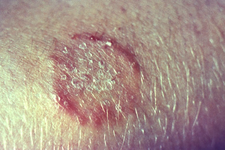 This photograph depicted a wheel-shaped, cutaneous lesion, commonly referred to as ringworm, which had been caused by the dermatophytic fungal organism, Trichophyton mentagrophytes.