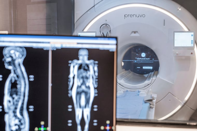 One in five men over age 50 will suffer an osteoporotic fracture at some point, but screening for men faces many obstacles. (Prenuvo via AP)