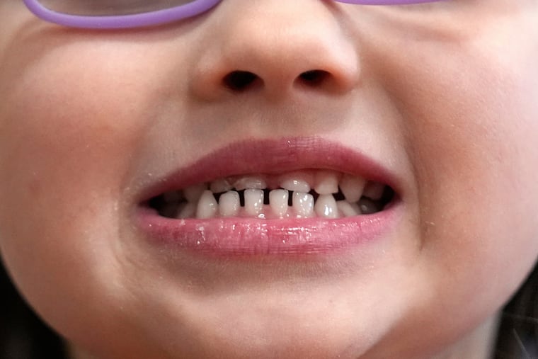 A child shows off her teeth after a dental exam in Concord, N.H., Wednesday, Feb. 21, 2024. Fluoride treatments have gotten caught in the culture wars. (AP Photo/Robert F. Bukaty, file)
