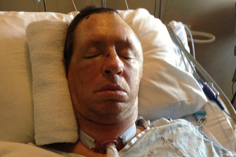 G2NPCBEAT17C - Doctors at Einstein Medical Center gave Robert Barnes a tracheotomy yesterday, as he remains in a medically induced coma. (Courtesy Diane Barnes)