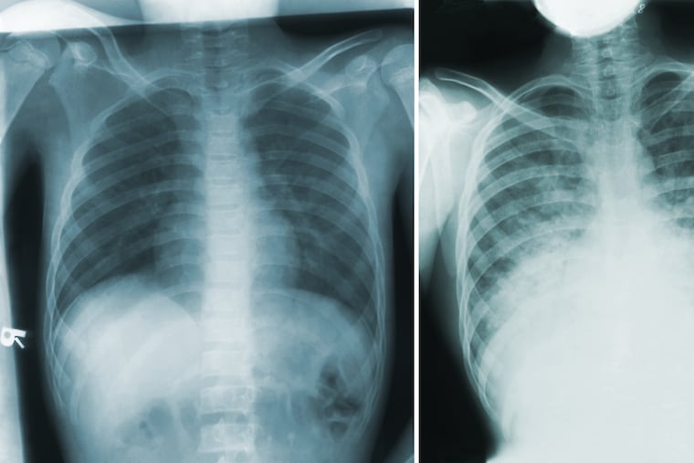 A chest X-ray shows a patient with apparently normal lungs, left, and another X-ray of the same patient one day later with pulmonary infiltrates caused by a case of pneumonic plague. MUST CREDIT: S. Brodsky/Centers for Disease Control and Prevention