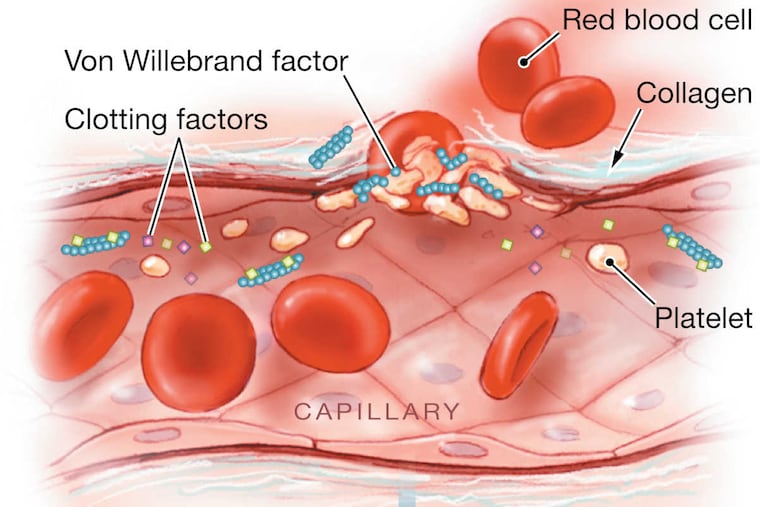 When an injury occurs to a blood vessel, cells called platelets form a protective plug, which is then held in place with a mesh of proteins called fibrin. The body makes 13 clotting factors to steer this coagulation "cascade." If any one of them is deficient, a bleeding disorder can result. Hemophilia is caused by low "activity levels" for factor VIII or factor IX, leading to painful bruising and swelling.