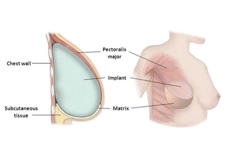 Surgeons use a biological tissue matrix, or "surgical mesh," to act as a supportive sling under the reconstructive breast implant, which is placed behind the pectoralis muscle.