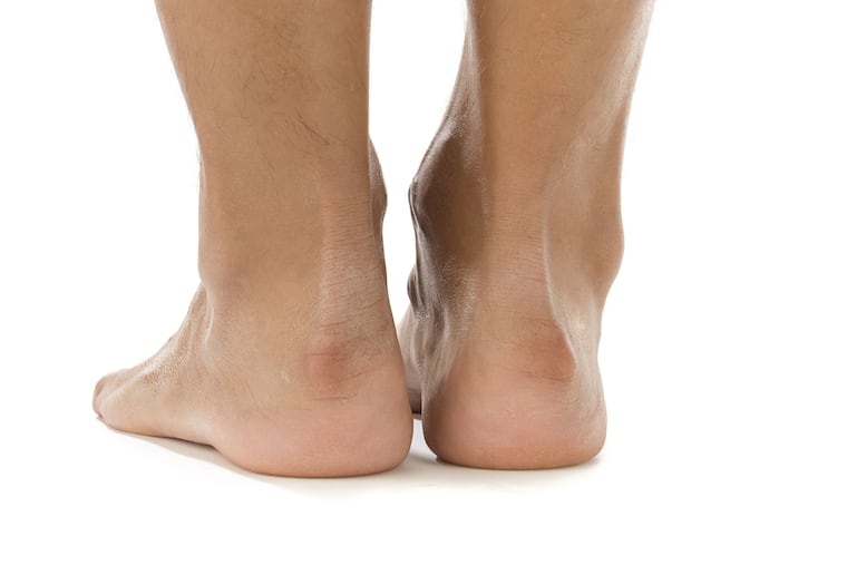 A thicker Achilles tendon is directly related to cholesterol levels.