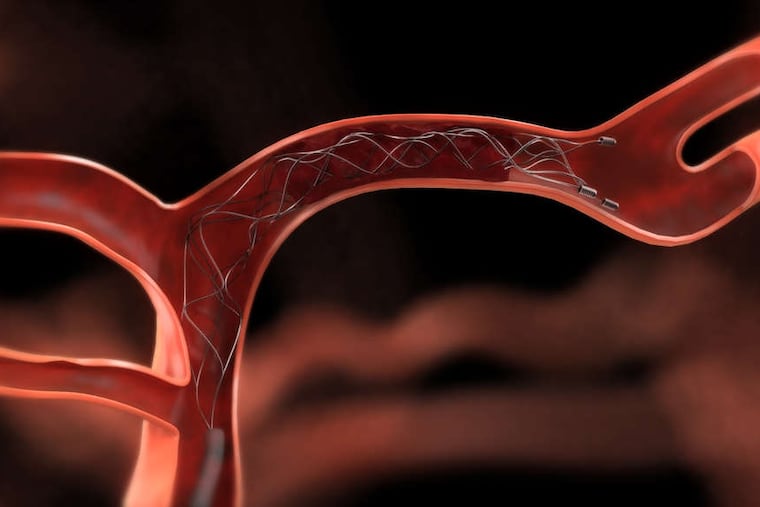 Illustration showing a stent that has been threaded through an artery.