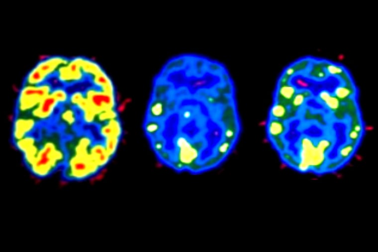 Enhanced PET scans using radioactive tracers show reduced neurotransmitter activity even months after last cocaine use. Cocaine affects brain activity very differently ó and more visibly ó than opioids. But addictions of all kinds can change responses in ways that are beyond an individualís control. SOURCE: Nora D. Volkow, et. al. (1993)