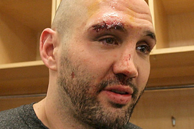 Ian Laperriere shows off his face after getting hit by a puck. Laperriere needed more than 60 stitches. (Yong Kim / Staff Photographer)