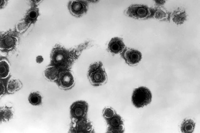This 1981 electron microscope image made available by the Centers for Disease Control and Prevention shows varicella-zoster virions from a patient with chickenpox. Philadelphia health officials recently reported an uptick in chickenpox cases among children.