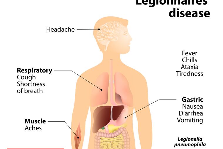 Legionnaires disease or legionellosis or Legion fever. Signs and symptoms is a form of atypical pneumonia. Human silhouette with highlighted internal organs